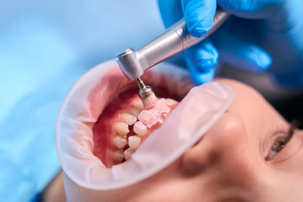 Niño recibiendo tratamiento dental con un cepillo rotatorio en la consulta odontológica, mientras un dentista utiliza guantes y una protección para la boca.